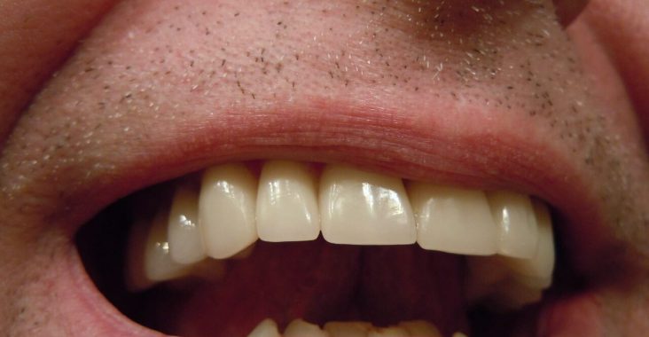 Usuwanie przebarwień z zębów