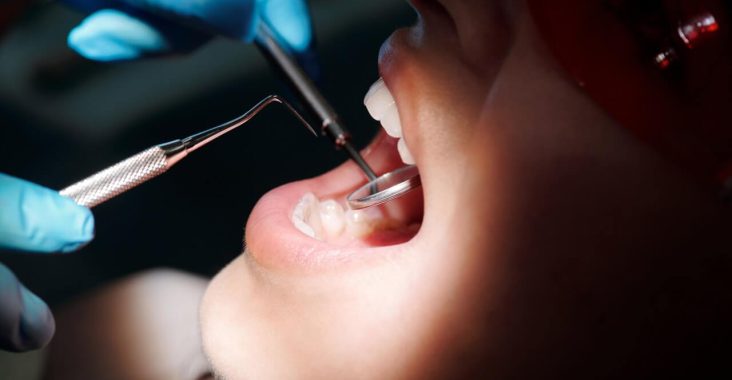 Czy należy usunąć stare wypełnienie amalgamatowe i jak usunąć plombę z zęba?
